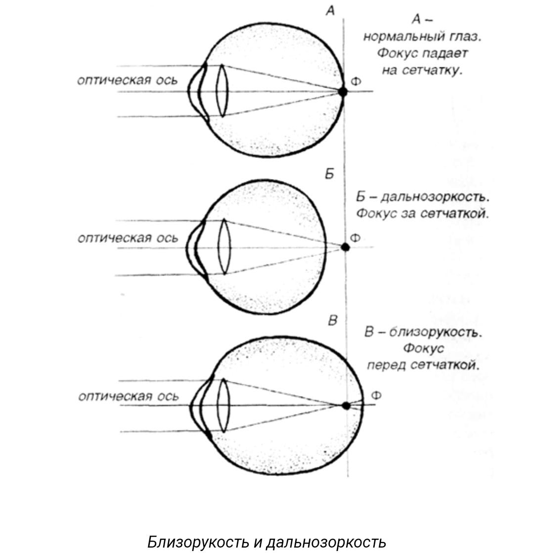 Наружная и внутренняя ось глаза. Аномалии рефракции глаза (близорукость, дальнозоркость, астигматизм). Продольная ось глаза. Схема горизонтального сечения правого глаза. Продольная ось глаза.