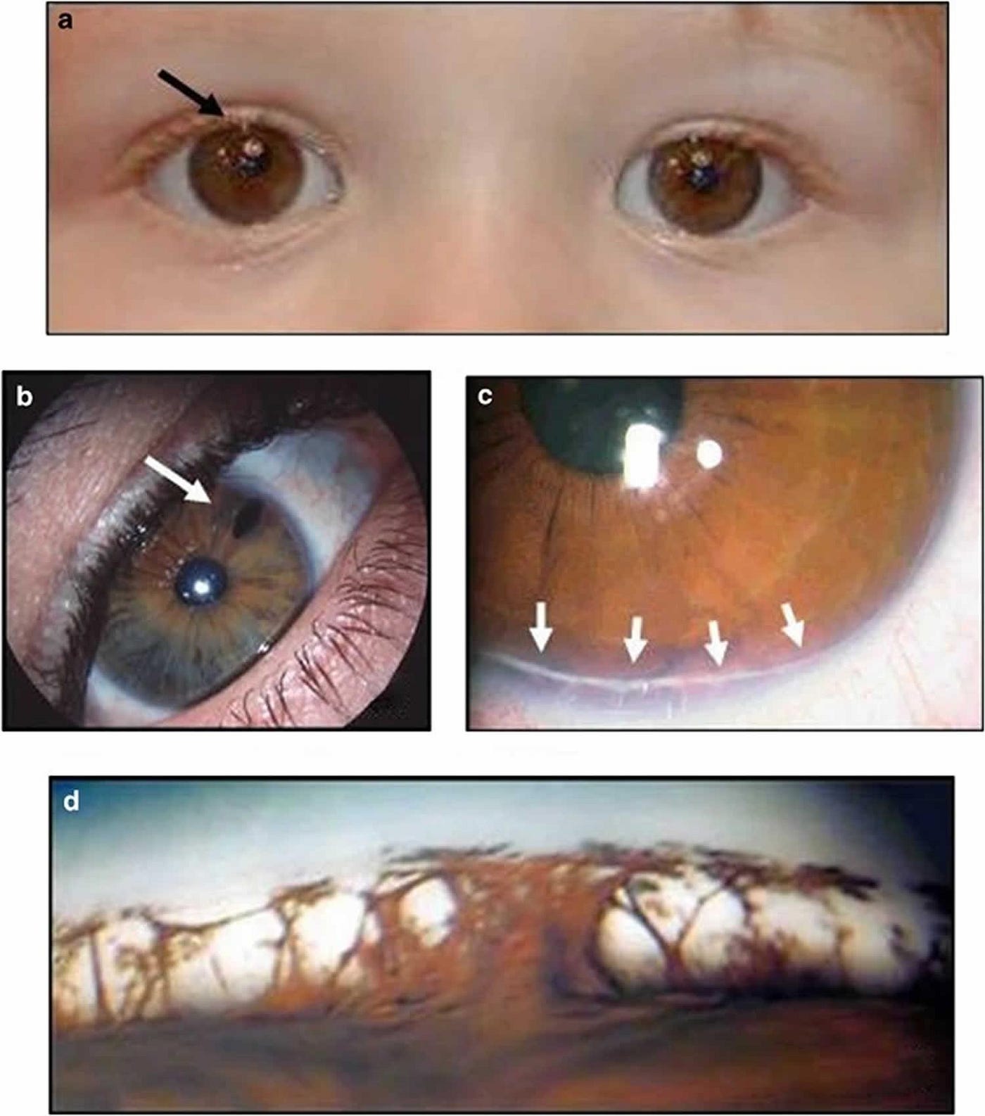 Understanding Axenfeld-Rieger Syndrome what to know