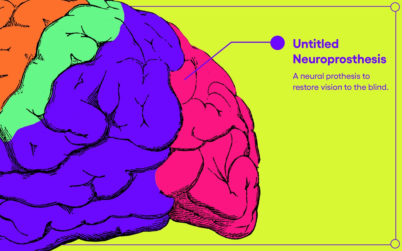 Here Are the Major Advances in Brain Implants That Happened ...