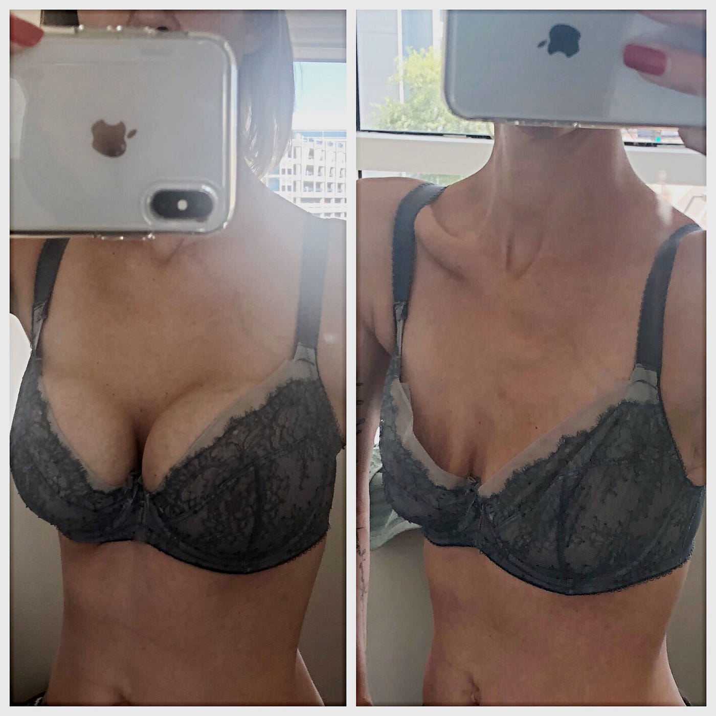 What Happened When I Had My Breast Implants Removed, by Upvirket