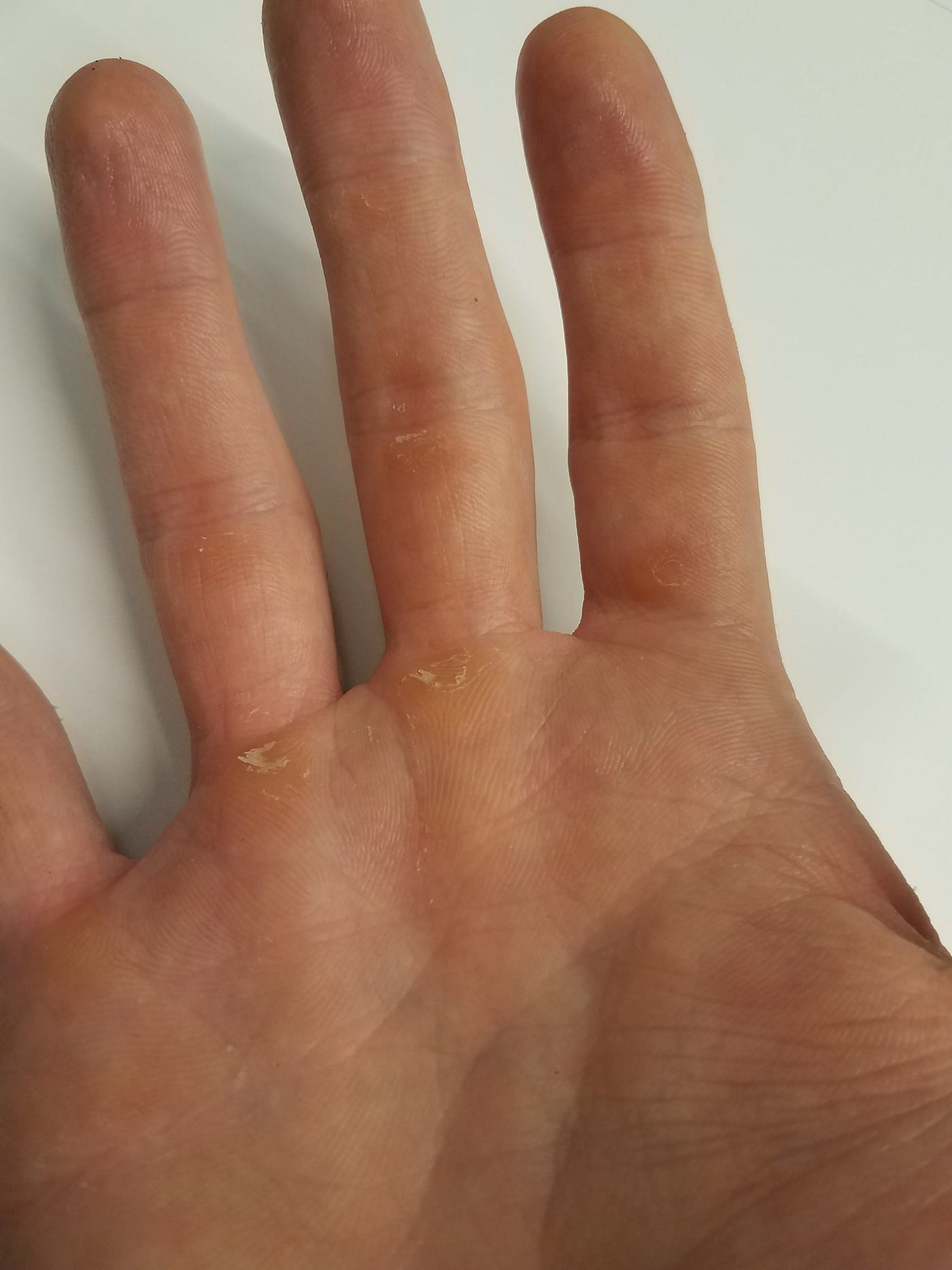 Calluses on hands guitar deals