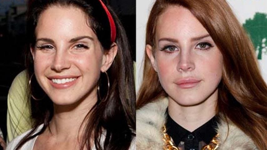 LANA DEL REY PLASTIC INSIGHT. Lana Del Ray is an American singer… | by VIEW  PLASTIC SURGERY | Medium