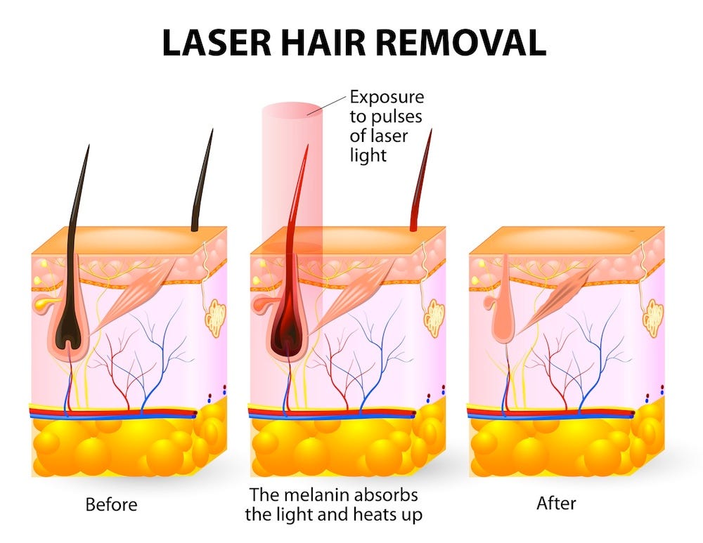 Laser Hair Removal Answers To Faqs by laserhairremoval810 Medium