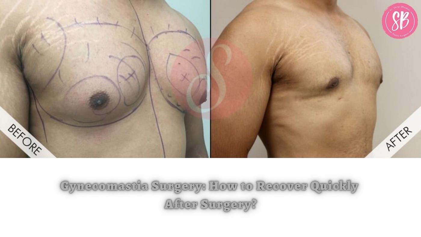 Male Breast Surgery Recovery