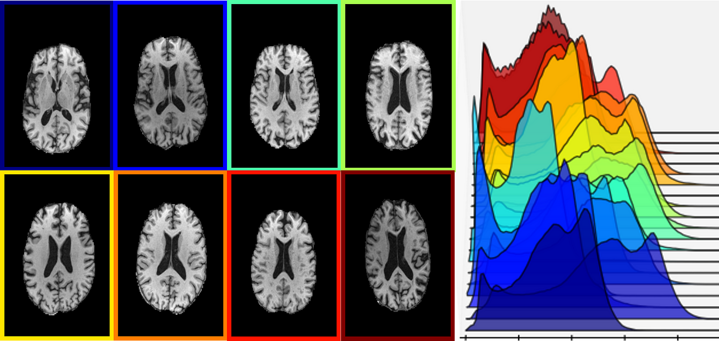 Image Intensity Normalization in Medical Imaging, by Susanne Schmid