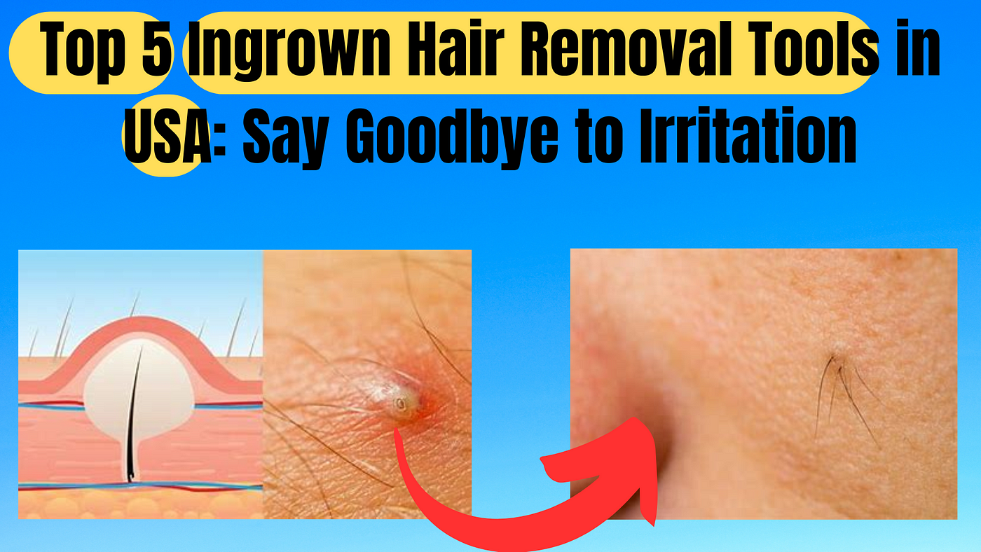 Best Top 5 Ingrown Hair Removal Tools in USA Say Goodbye to