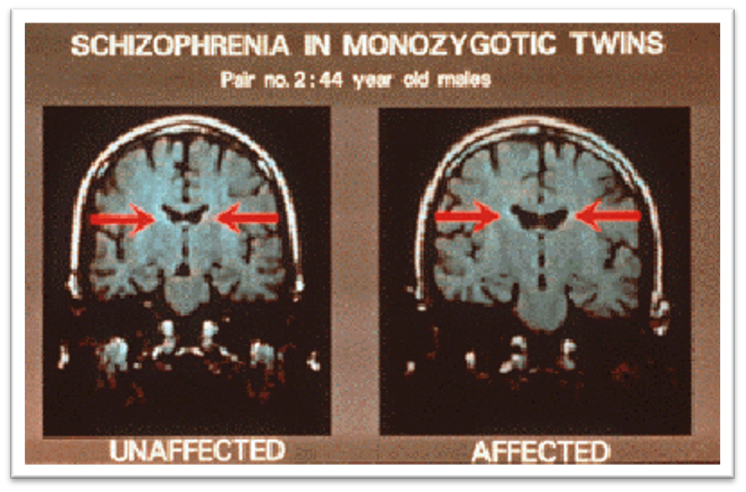 schizophrenia brain ventricles