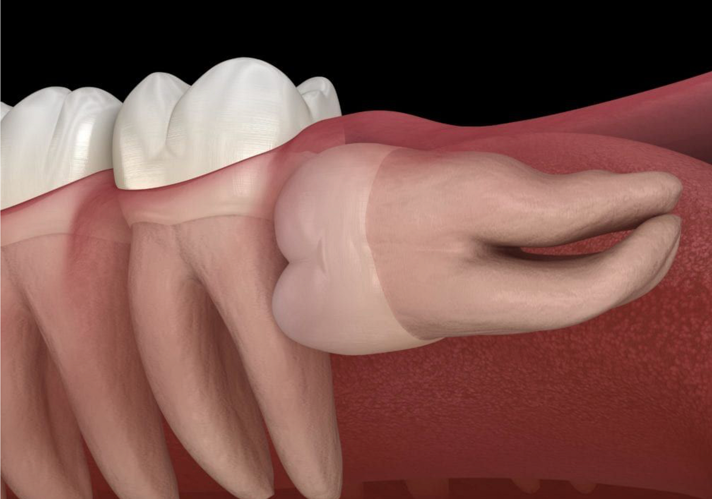 The Wisdom Tooth That Finally Taught Me Wisdom