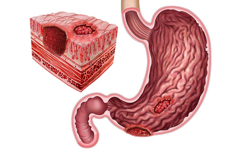 Эрозивный гастродуоденит — Teletype