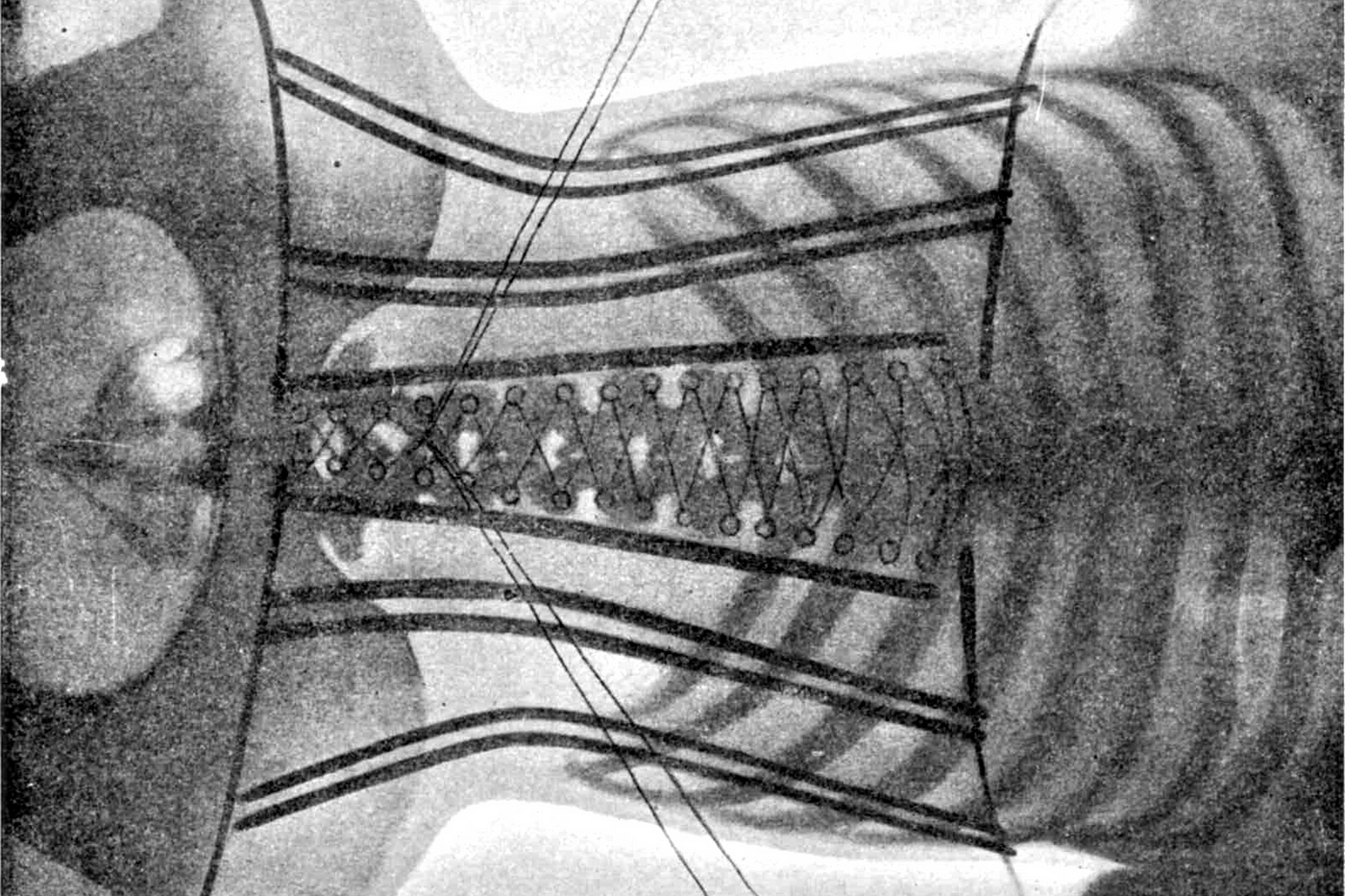 X-Rays Exposed the Corset's Lethality, by C.S. Voll