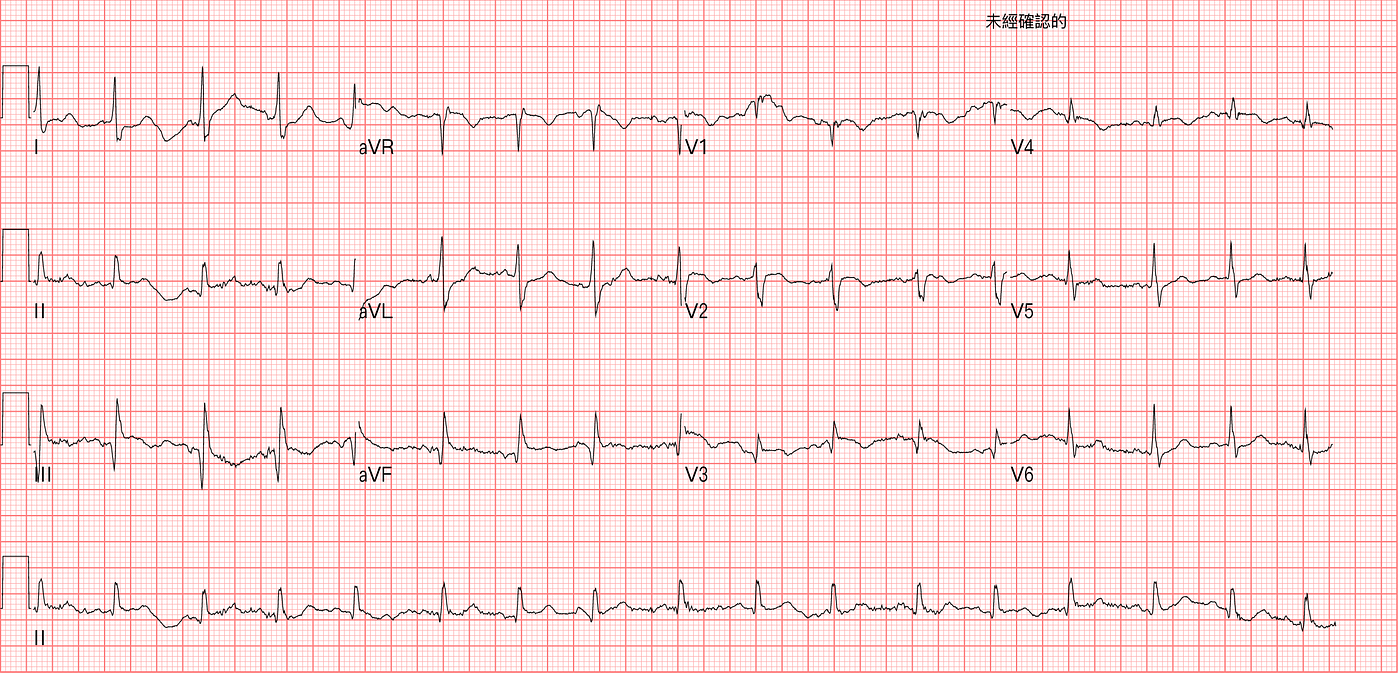 低血壓、低血氧到院，心電圖有問題嗎?. 72歲女性，由救護車偶依～～～～偶依送到本院。 | by Tsao Jian-hsiung | Medium