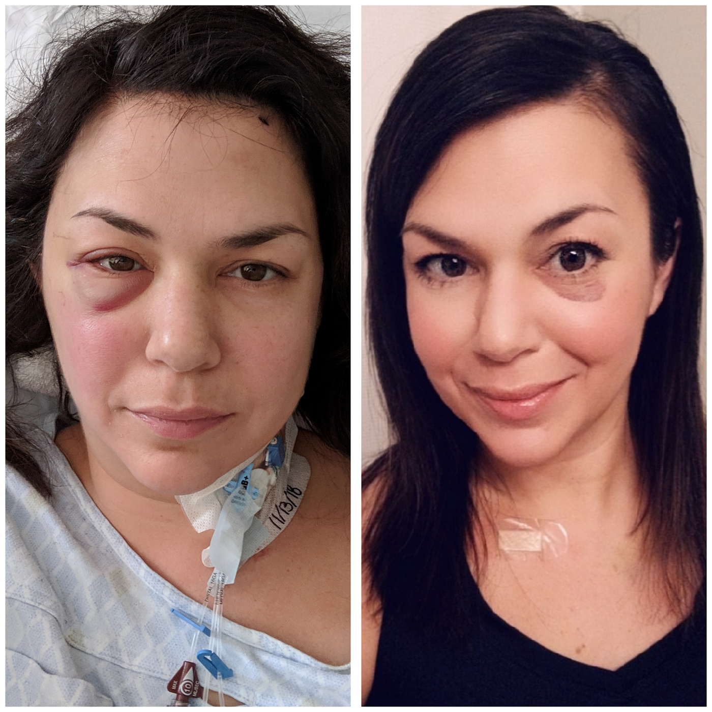 18+ Gifts For Surgery Recovery