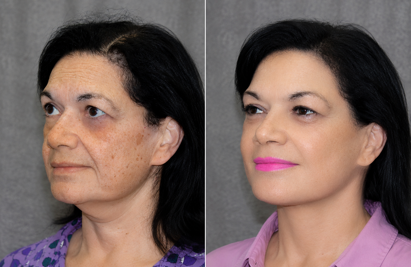 Neck Lift on Long Island: What It Actually Fixes