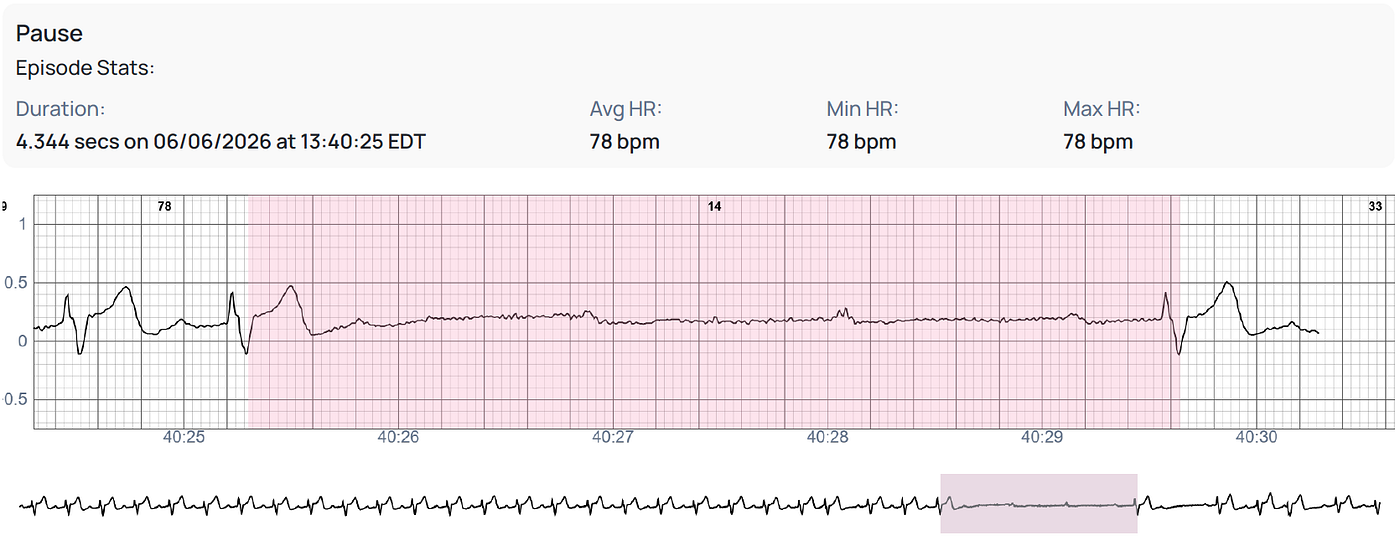 Delayed High-Grade AV Block After TAVR Detected During Post-Discharge Mobile Cardiac Telemetry…