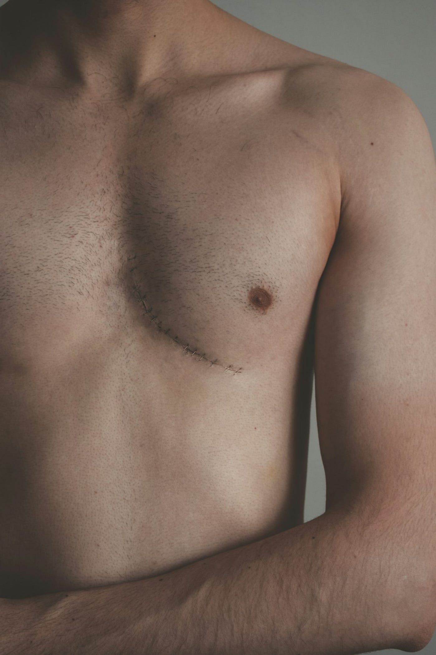 Breast Cancer in Men, The Story Nobody Talks About