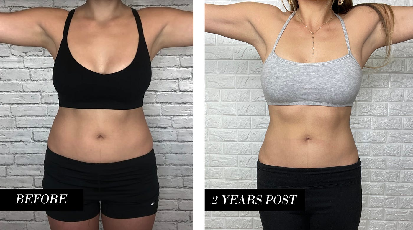 Airsculpt 2-Year Review: Would I do it all over again? (Before & After  Included), by Steph C. Martinez