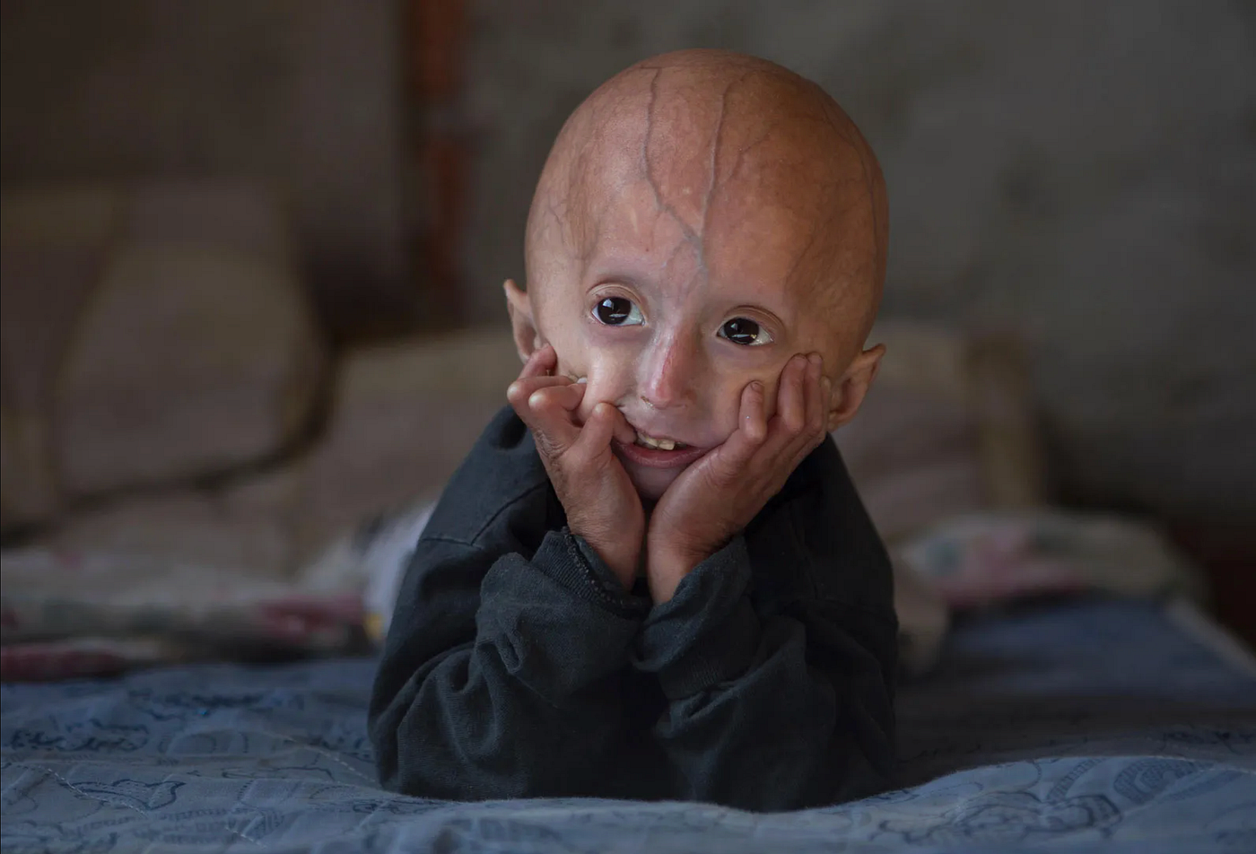 Stopping Hutchinson-Gilford Progeria Syndrome One Base Pair at a Time