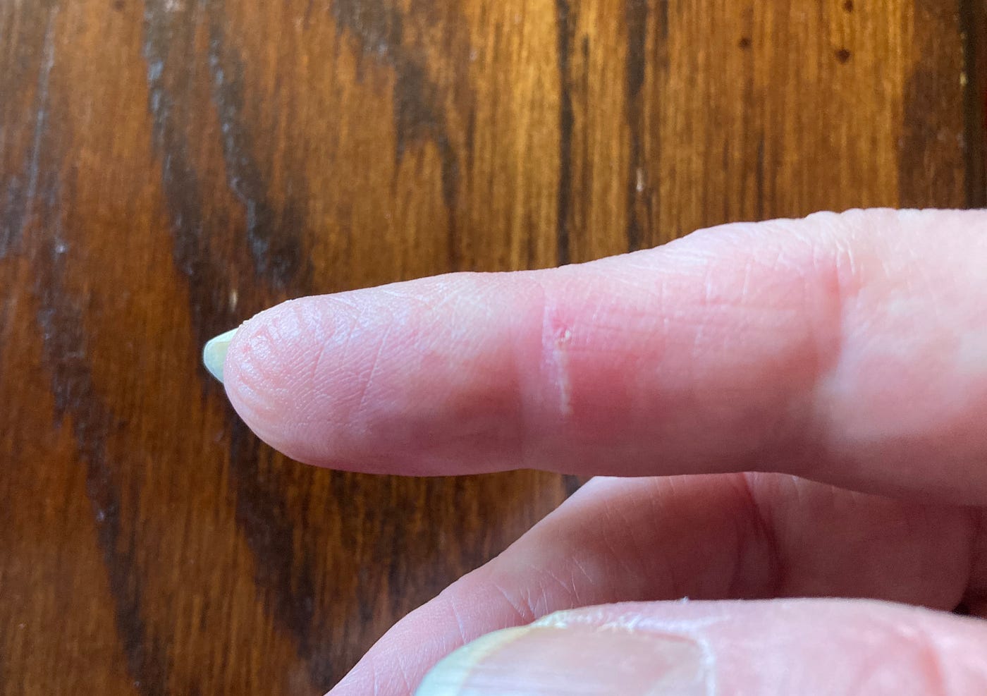 How to Remove a Splinter Under Your Fingernail: 10 Steps