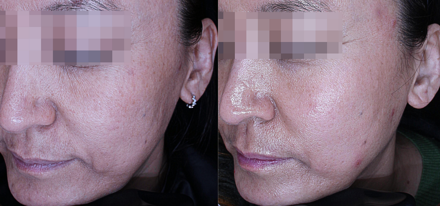 Before and After Thermage Treatment
