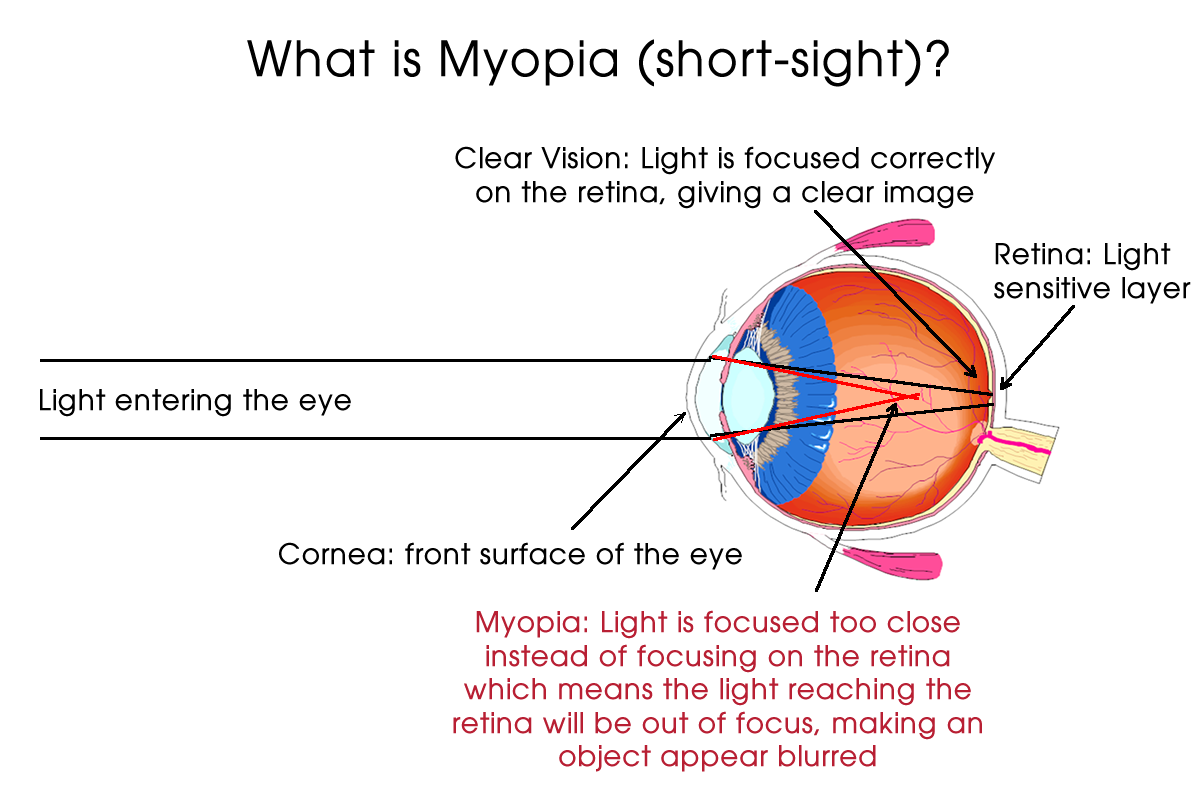 What is Myopia (Short-Sight)?. Myopia (also known as short sight or… | by  Bhavin Shah | My Kid's Vision | Medium