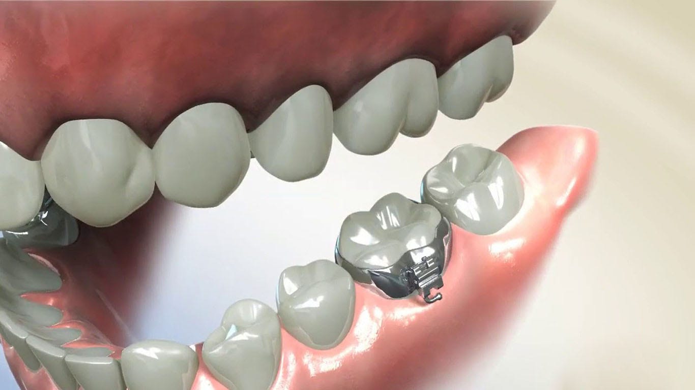 The 2023 Guide to Molar Bands — Pain, Relief, Tips, and FAQs