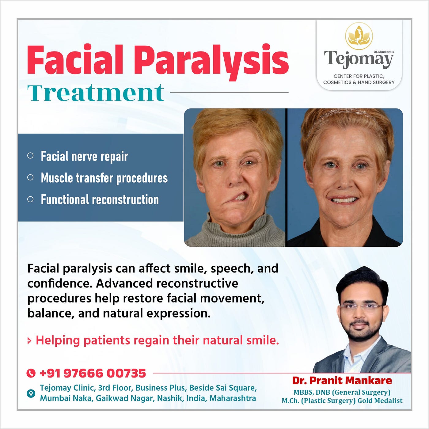 Plastic Surgeon in Nashik | Facial Paralysis Treatment in Nashik | Facial Nerve Repair by Dr.