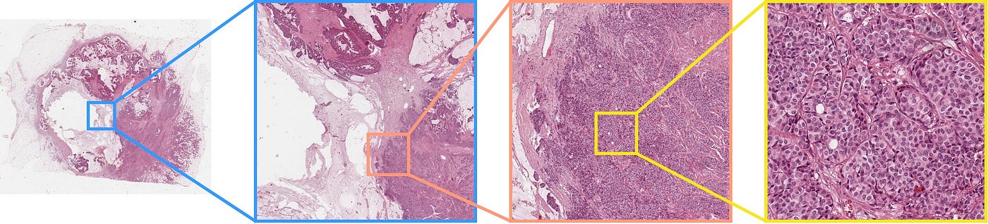 Zooming in on a whole-slide image is as fun as zooming in on satellite imagery. After chasing down larger structures, one can find the cells that form the tissue, in various shapes and sizes (source: Lunit SCOPE demo)