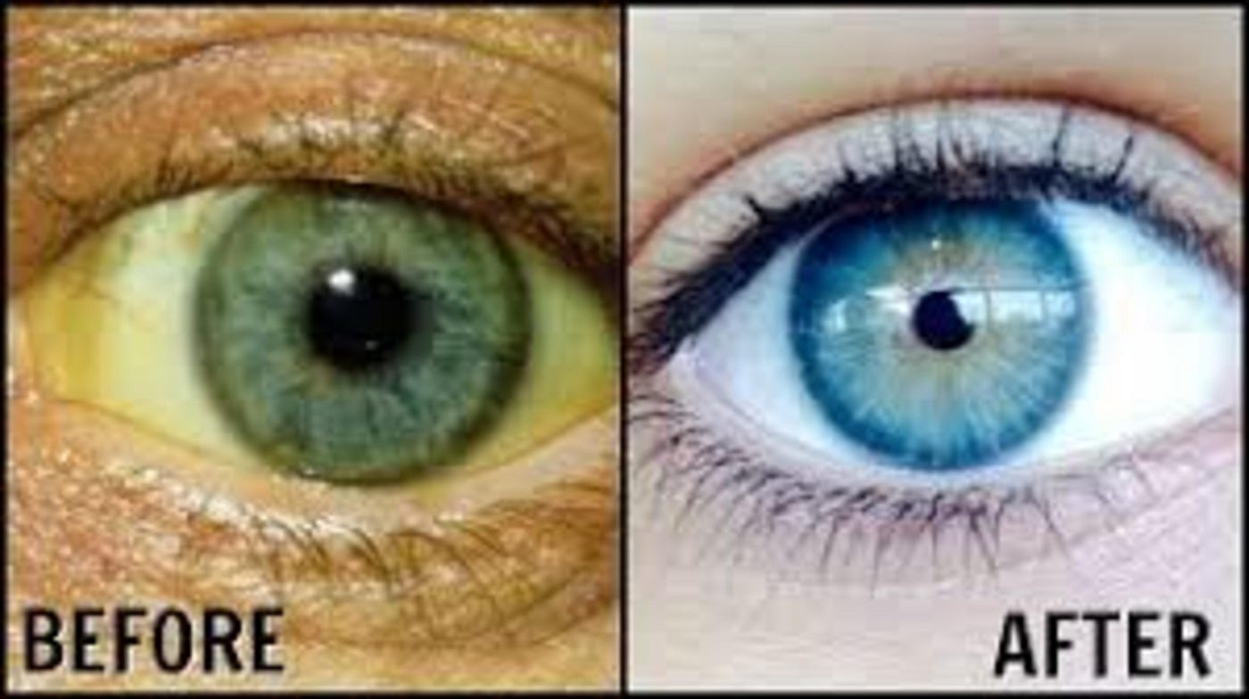 5 Natural Ways to Get Whiter Eyes | by Chuks Gad Nwaigwe | Medium
