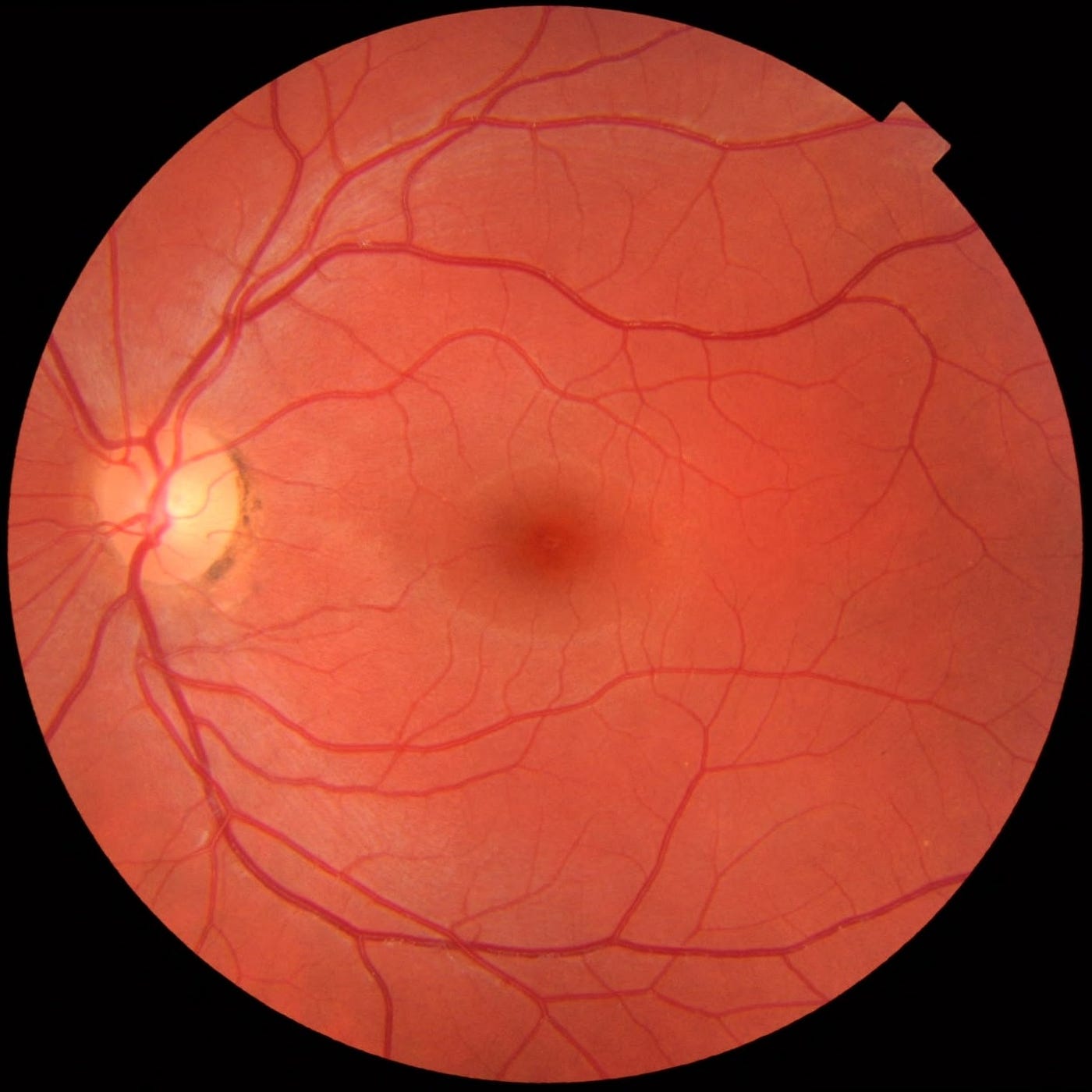 The Bionic Eye and Phosphenes: Seeing Flashes That Aren't There