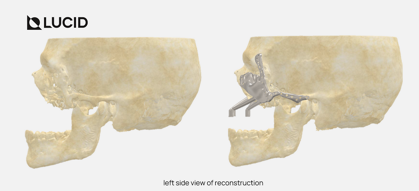 Post Black Fungus Infection Maxilla Reconstruction — A Case