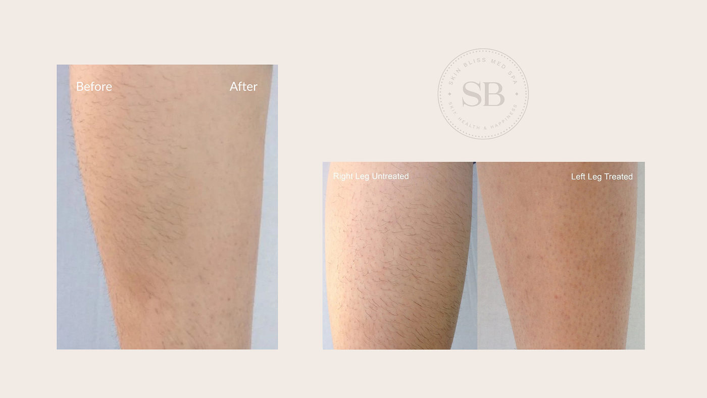 How Laser Hair Removal Actually Works