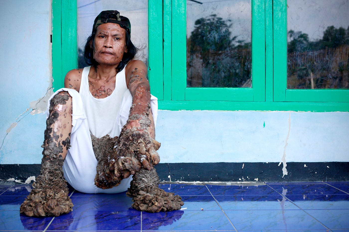 The Tree Man of Indonesia\, image size:1400x933