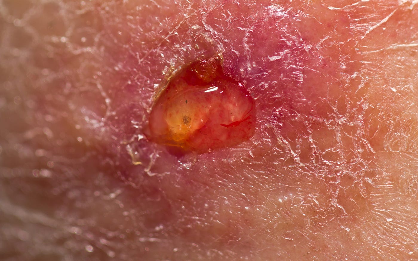 Arterial vs. Venous Ulcers: How to Tell the Difference and Why It Matters