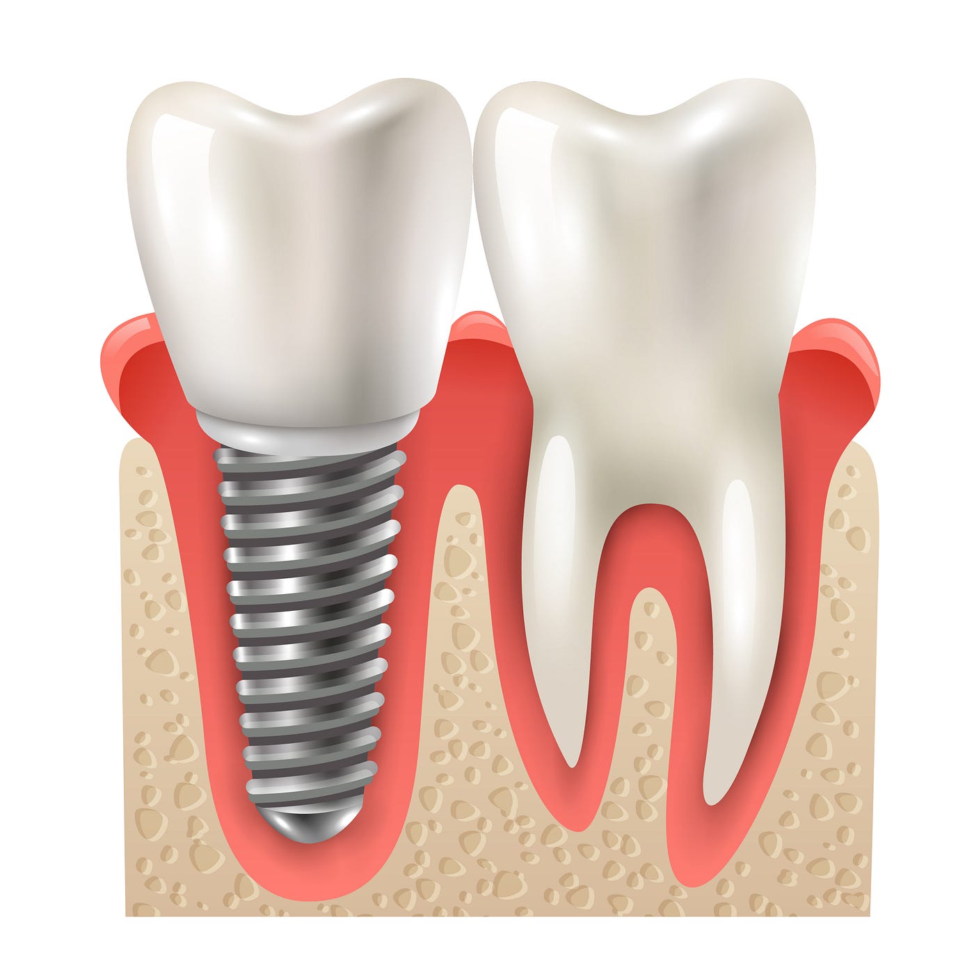 Reclaim Your Confidence: The Psychological Boost of Dental Implants | by  World of Dentistry | Medium