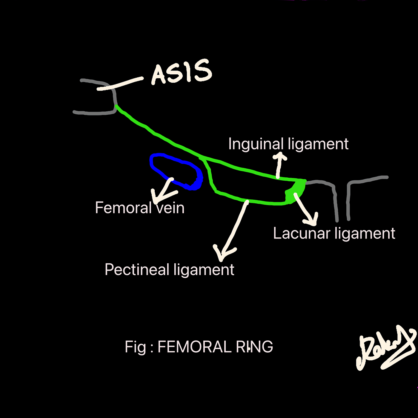 FEMORAL VS INGUINAL HERNIAS , SIMPLIFIED FOR MED STUDENTS !