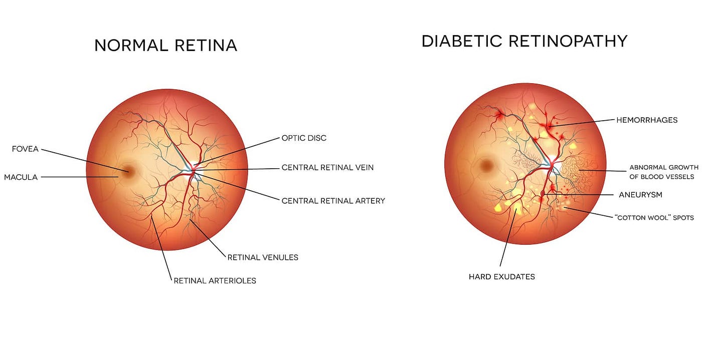 Living with Diabetic Retinopathy: My journey, My hope♥
