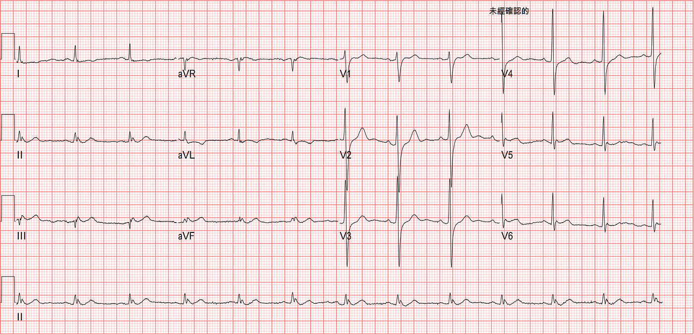 F/U ECG