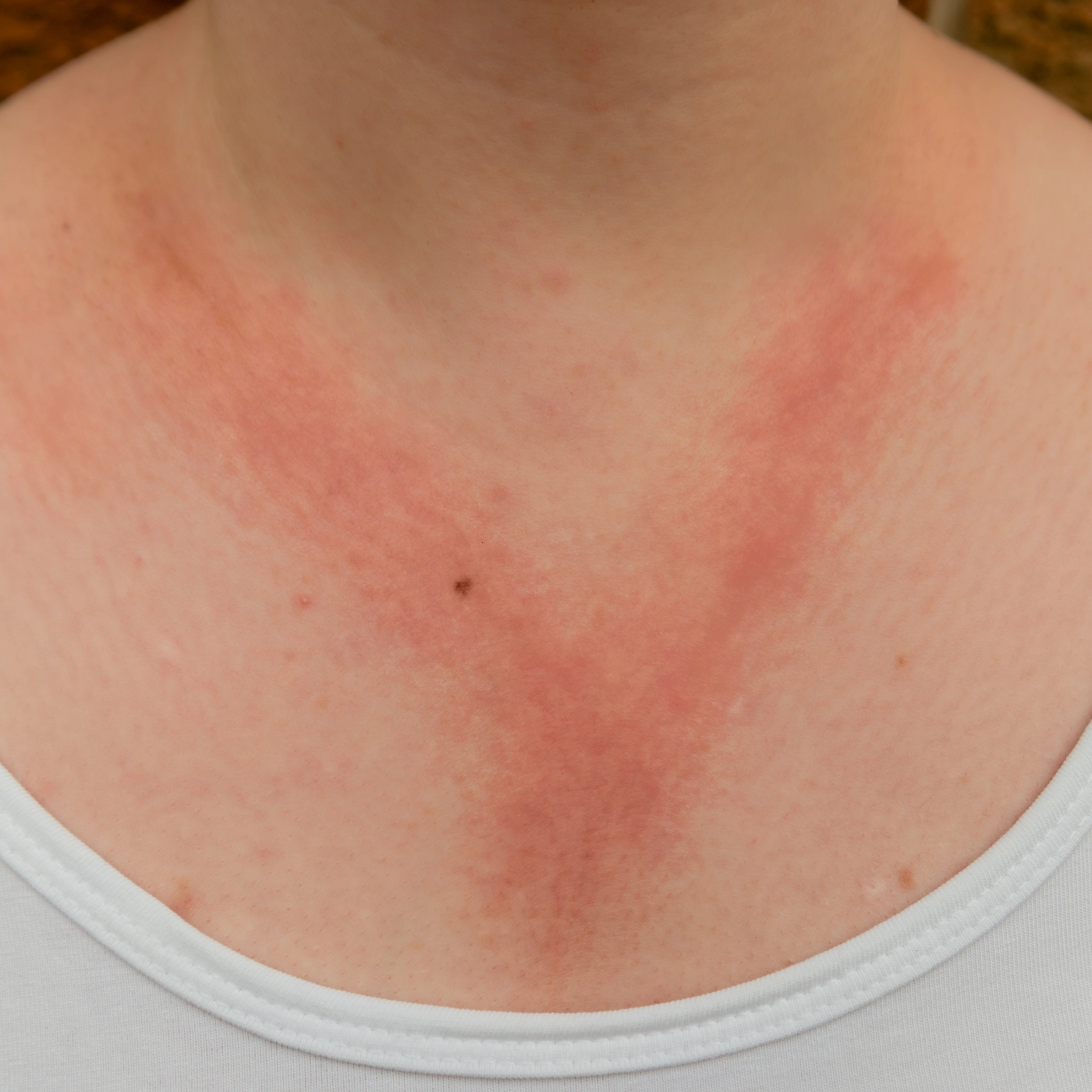 How to manage these common skin rashes?