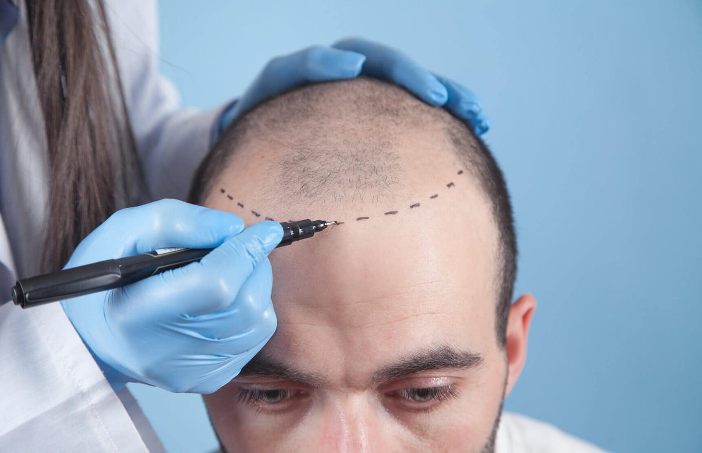 Rediscover Confidence Leading Hair Transplant Center  by syed ahmed   Medium