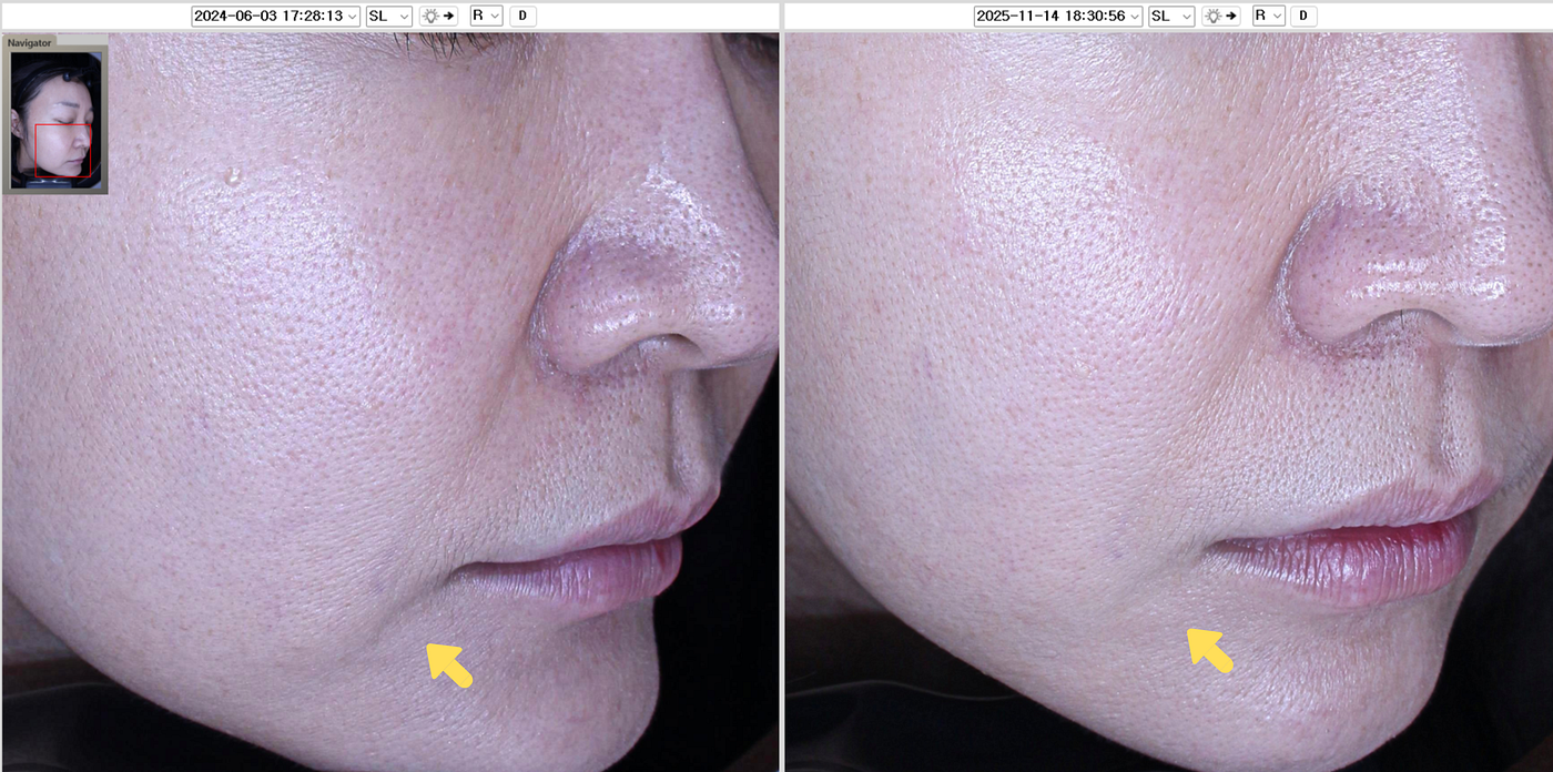 Jowl Reduction : Before and After