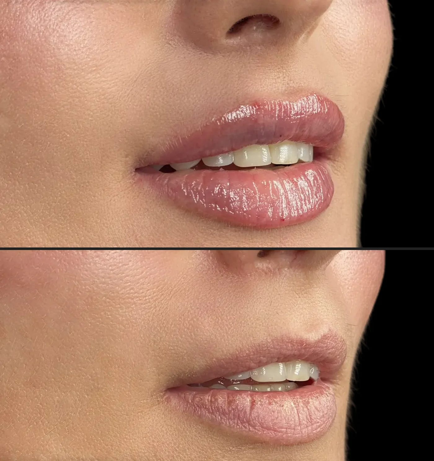 I Panicked After My Lip Fillers. Here’s What I Learned About Healing.