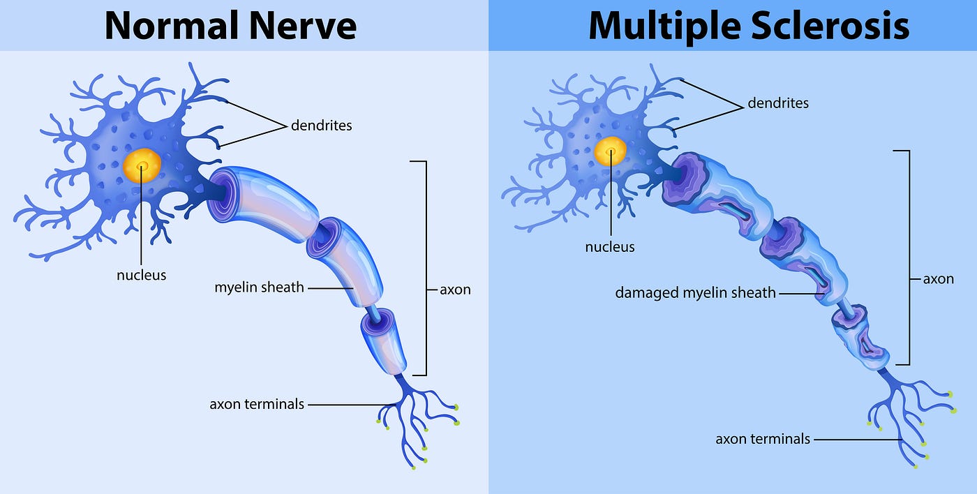Multiple Sclerosis and Upper Cervical Chiropractic