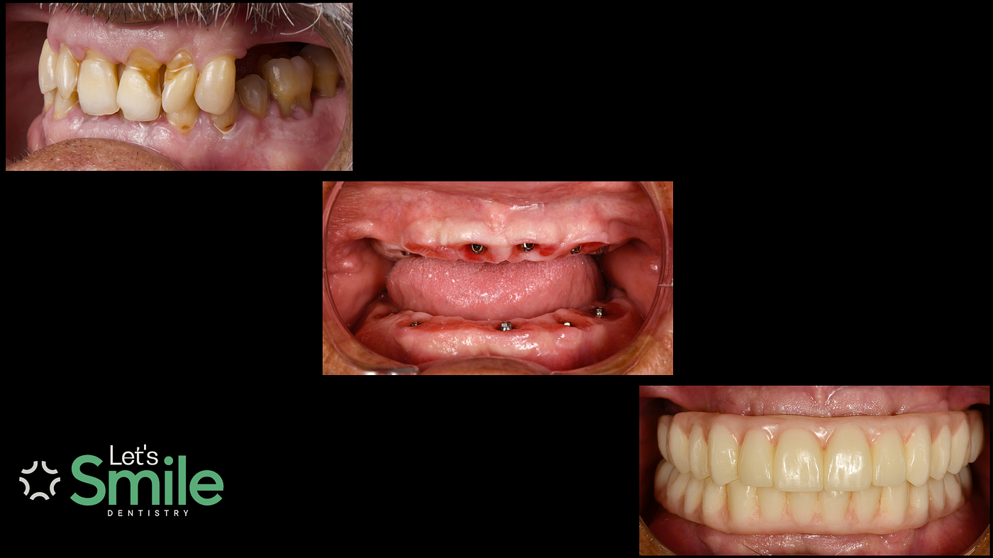 Full Mouth Restoration Dental Implants