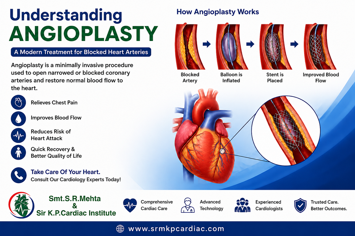 Angioplasty: A Modern Treatment for Blocked Heart Arteries