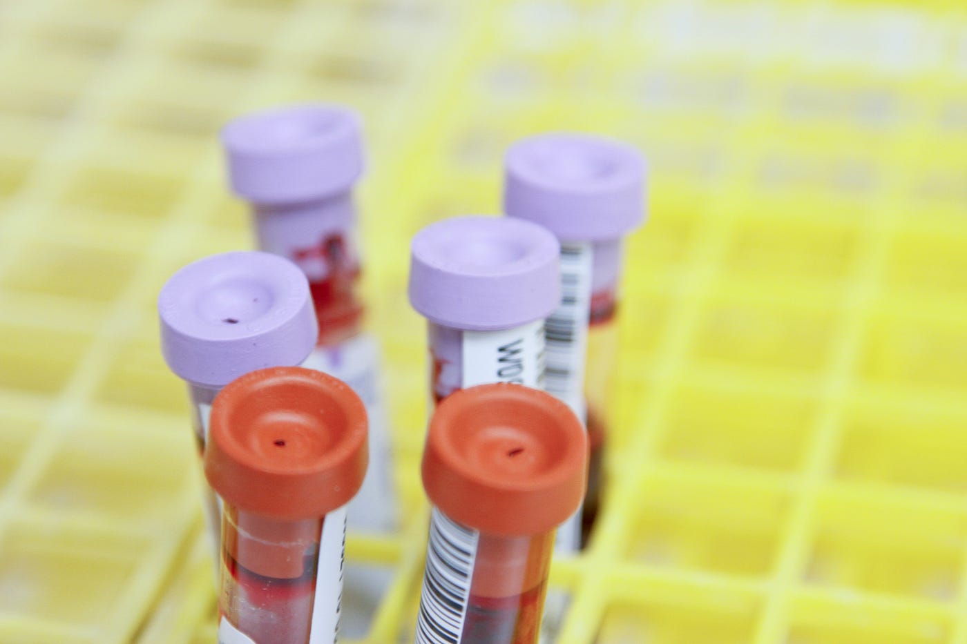When Bleeding Persists Despite Normal Testing