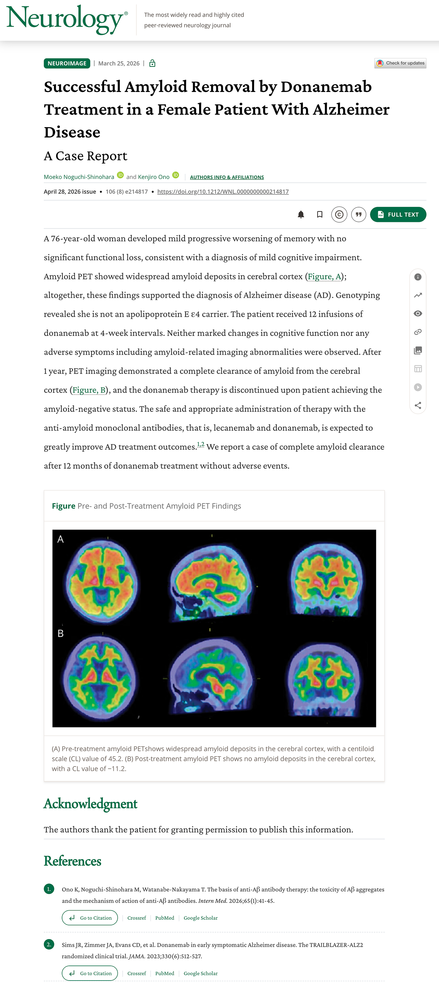 Donanemab: The Alzheimer’s Drug That’s Actually Clearing Plaques From Living Brains