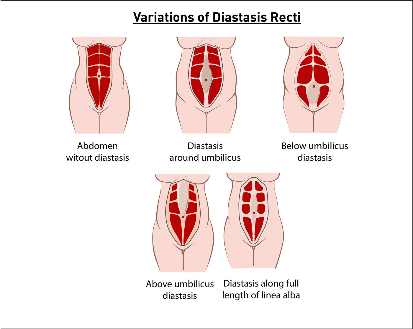 Diastasis Recti: A Scare Tactic Free Explanation, by Coach Kerri Grace