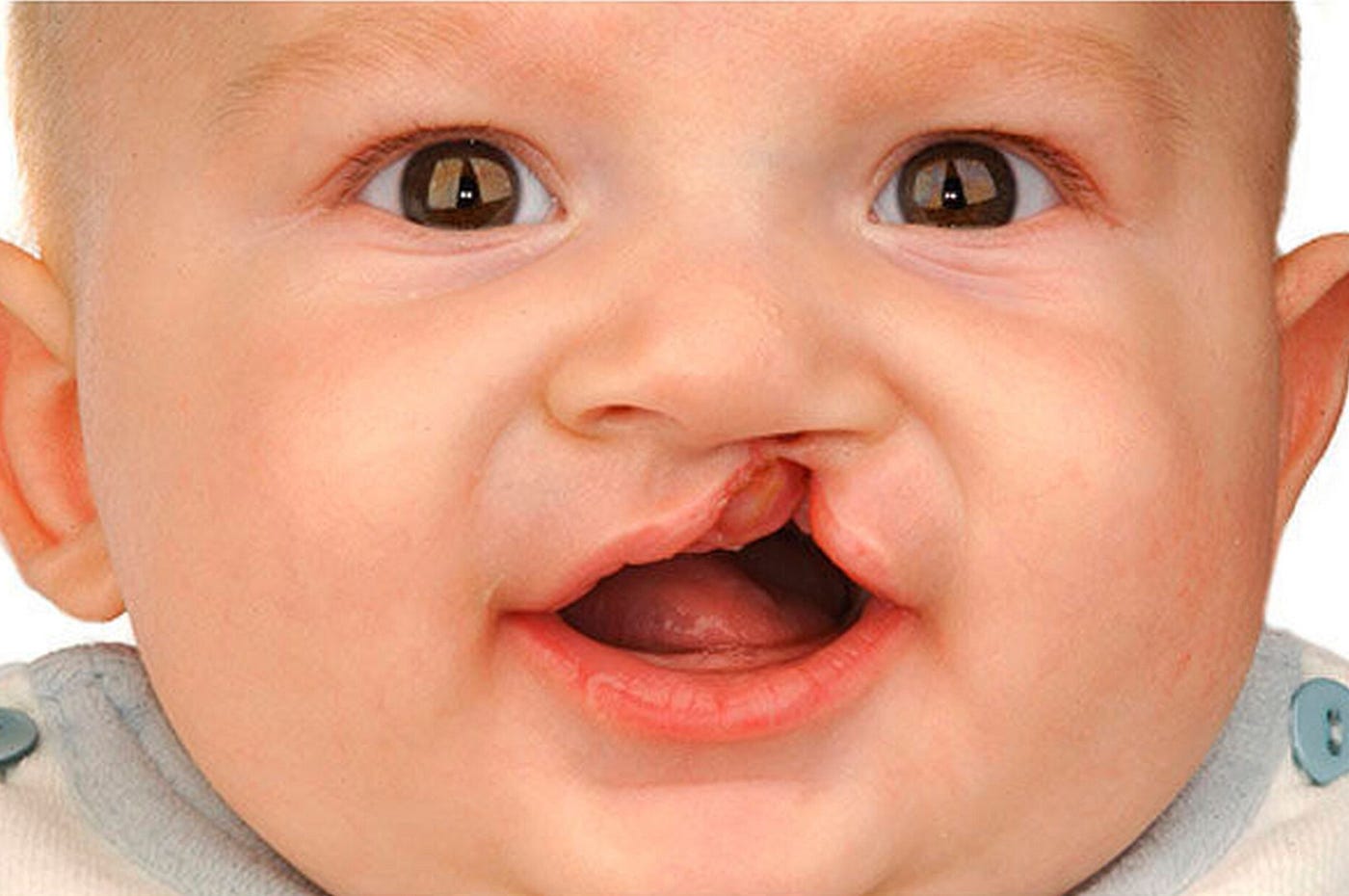 What are Cleft Lip and Palate? Causes, Types, and Audiological Effects
