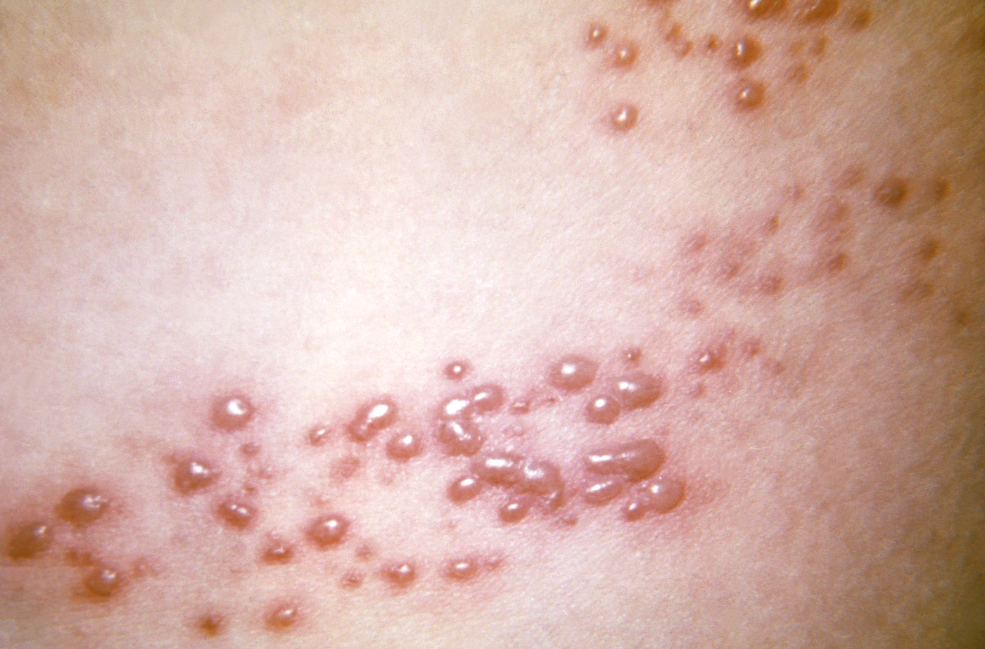 chicken-pox-rash-after-vaccine
