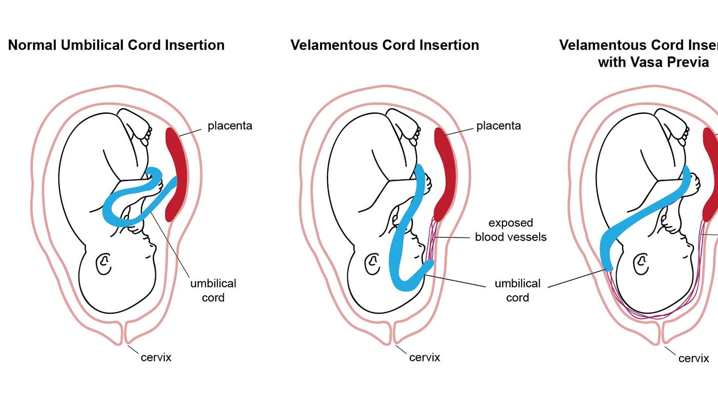 What Is Marginal Cord Insertion? - healtywealthy - Medium